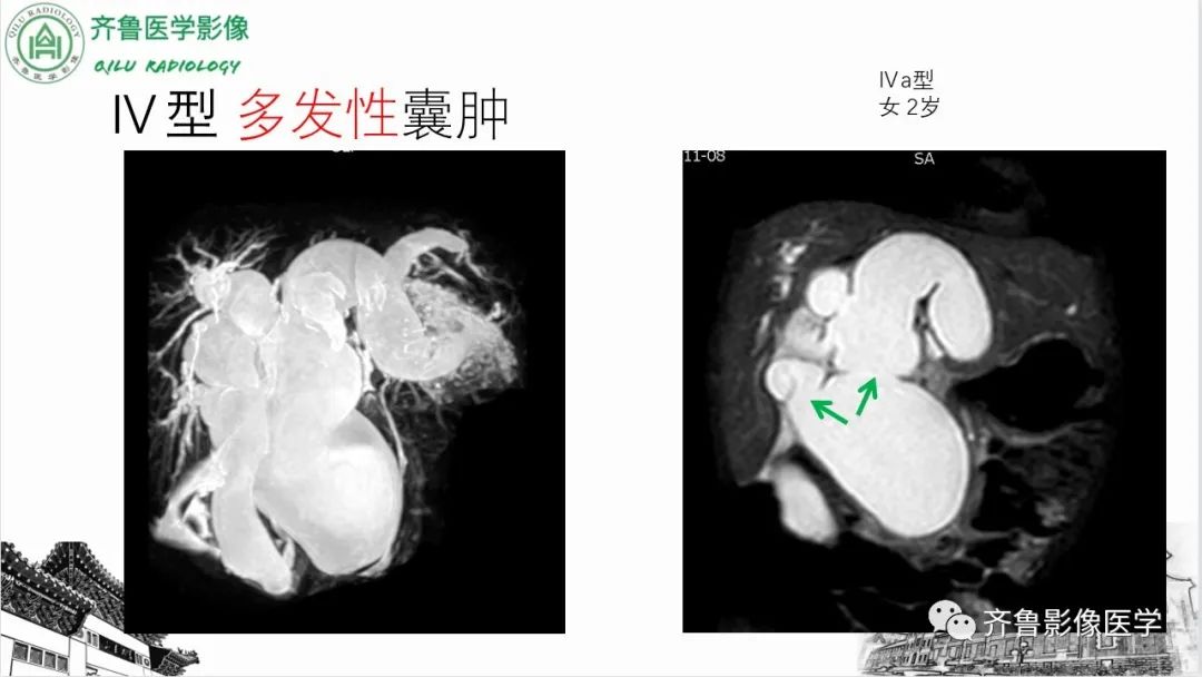 【PPT】先天性胆管扩张症-18