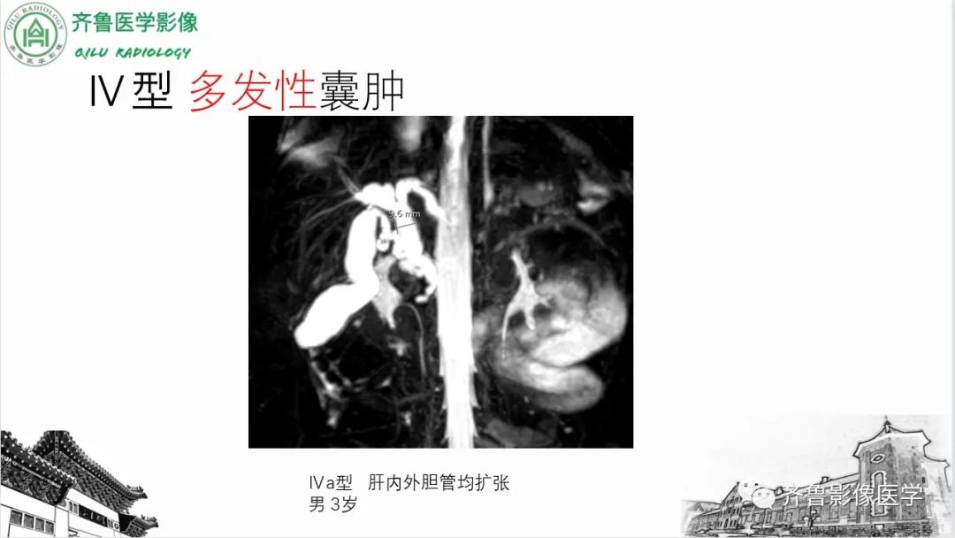 【PPT】先天性胆管扩张症-19