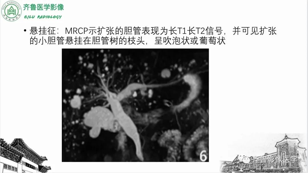 【PPT】先天性胆管扩张症-25