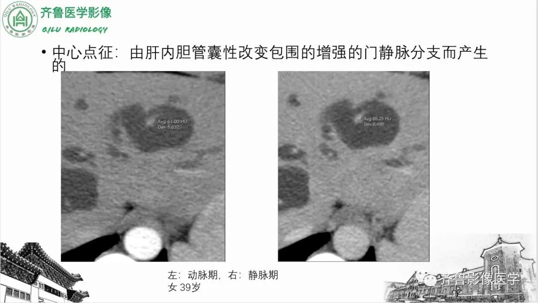 【PPT】先天性胆管扩张症-24