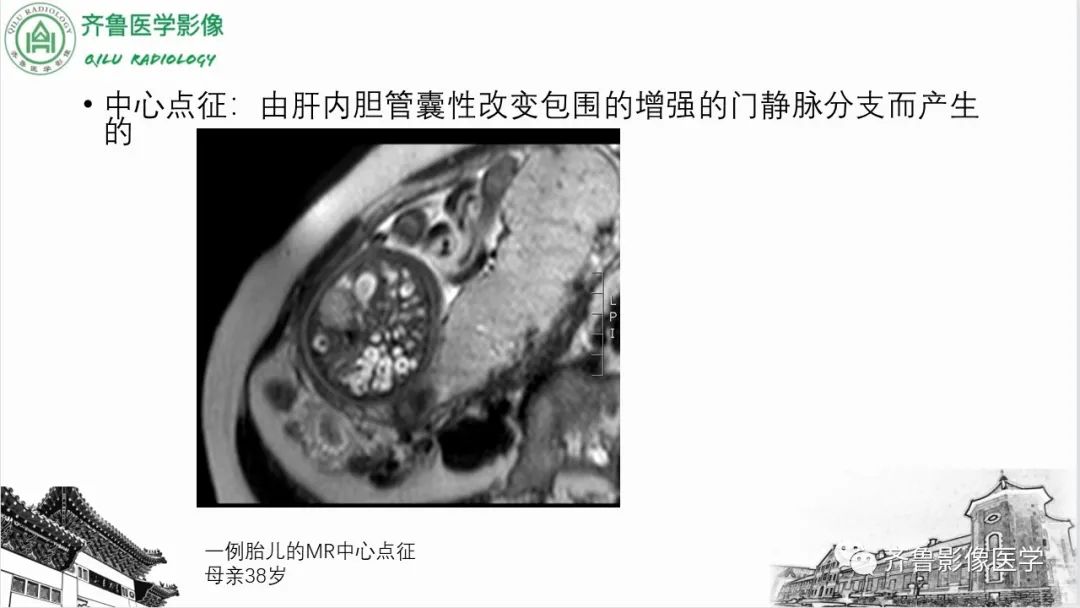 【PPT】先天性胆管扩张症-26