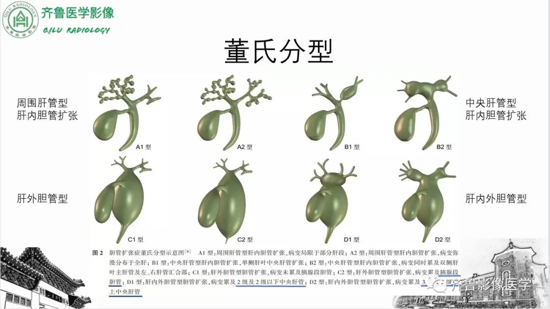 【PPT】先天性胆管扩张症-29