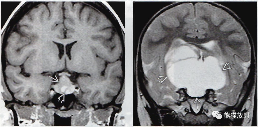 Rathke裂囊肿影像诊断要点-5