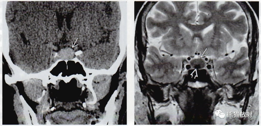 Rathke裂囊肿影像诊断要点-2
