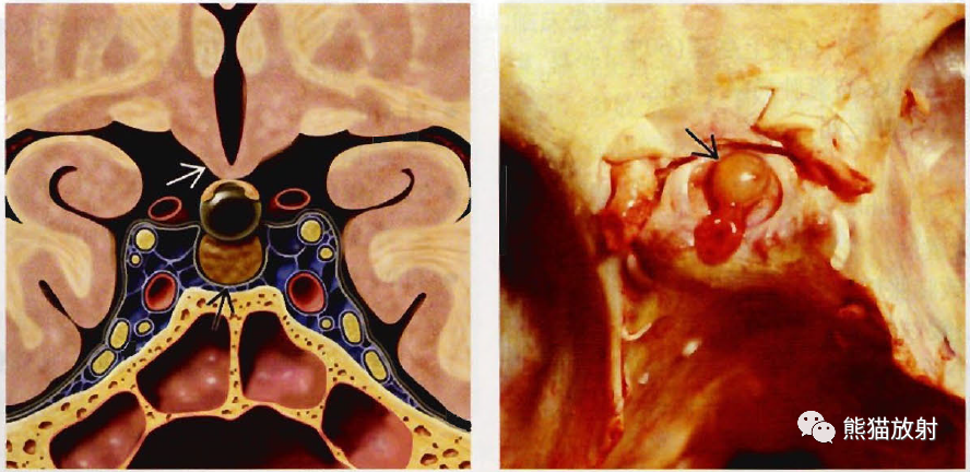 Rathke裂囊肿影像诊断要点-1
