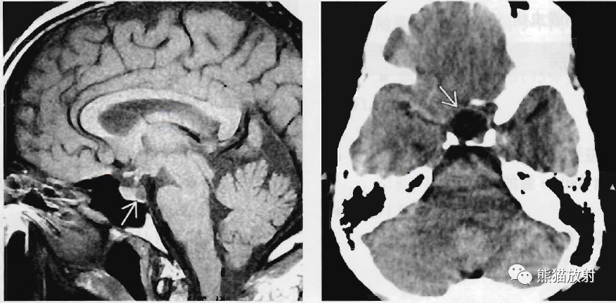 Rathke裂囊肿影像诊断要点-3