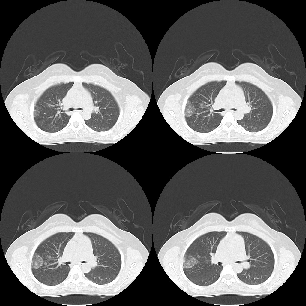 【病例】肺部子宫内膜异位症1例CT影像-1 【病例】肺部子宫内膜异位症1例CT影像-1