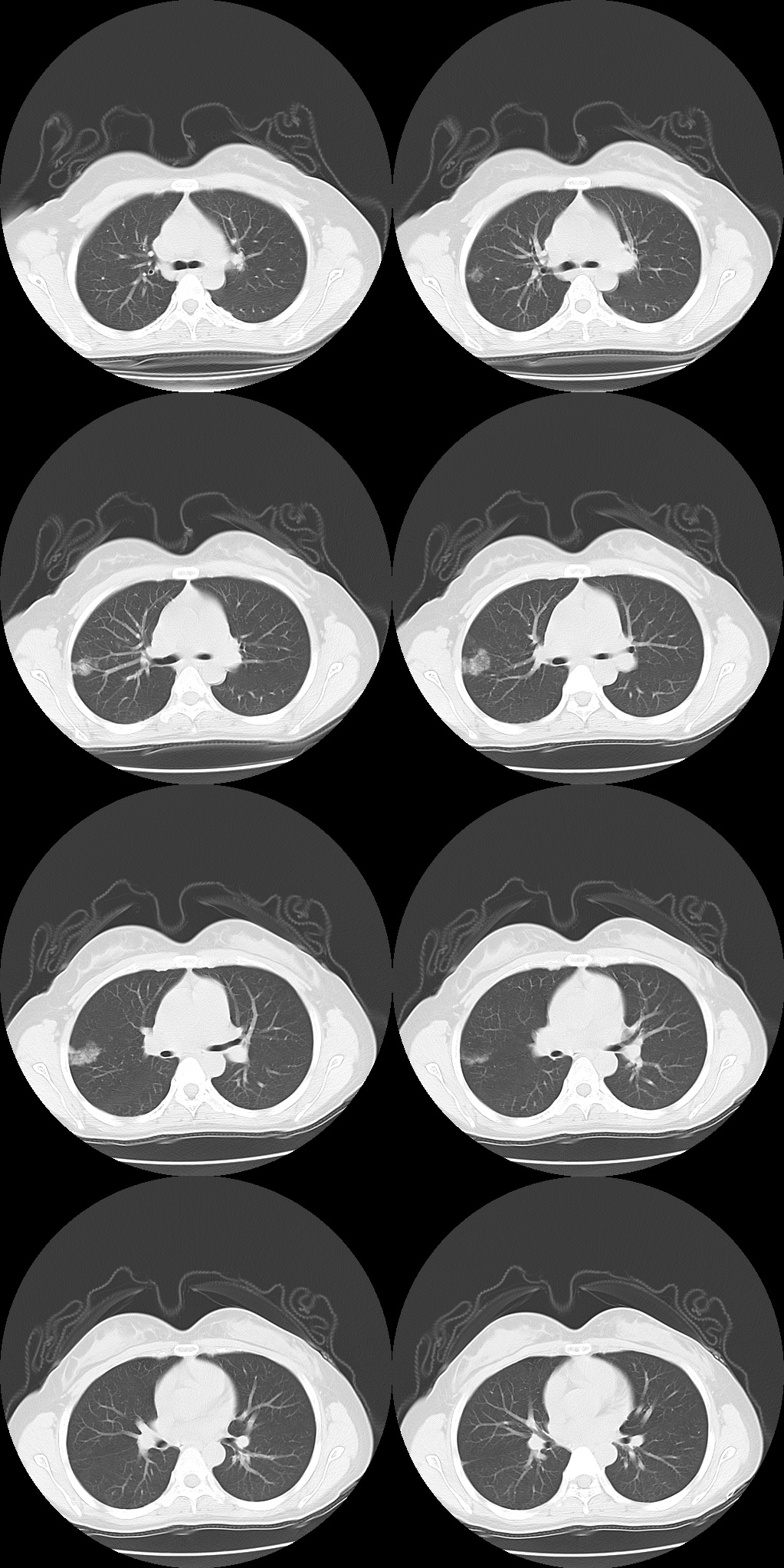 【病例】肺部子宫内膜异位症1例CT影像-5 【病例】肺部子宫内膜异位症1例CT影像-5