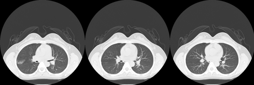 【病例】肺部子宫内膜异位症1例CT影像-2 【病例】肺部子宫内膜异位症1例CT影像-2
