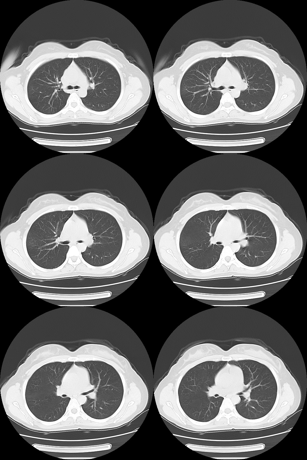 【病例】肺部子宫内膜异位症1例CT影像-6 【病例】肺部子宫内膜异位症1例CT影像-6