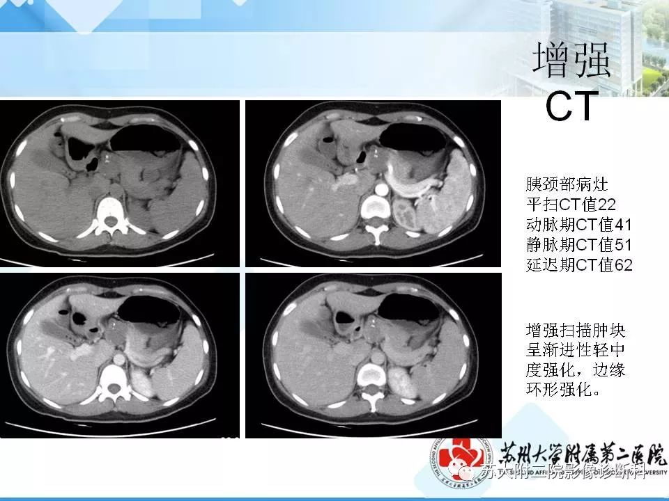 【病例】胰腺囊性病变3例影像诊断-7