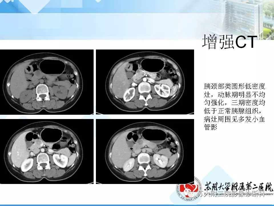 【病例】胰腺囊性病变3例影像诊断-18