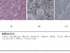 胰腺囊性病变3例影像诊断