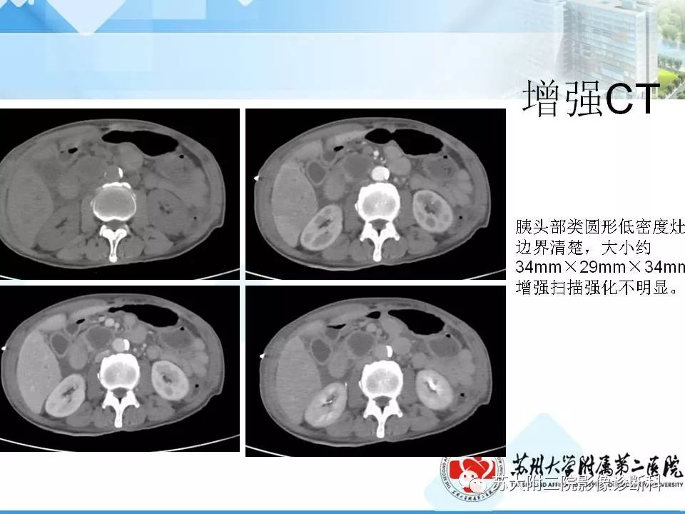 【病例】胰腺囊性病变3例影像诊断-28