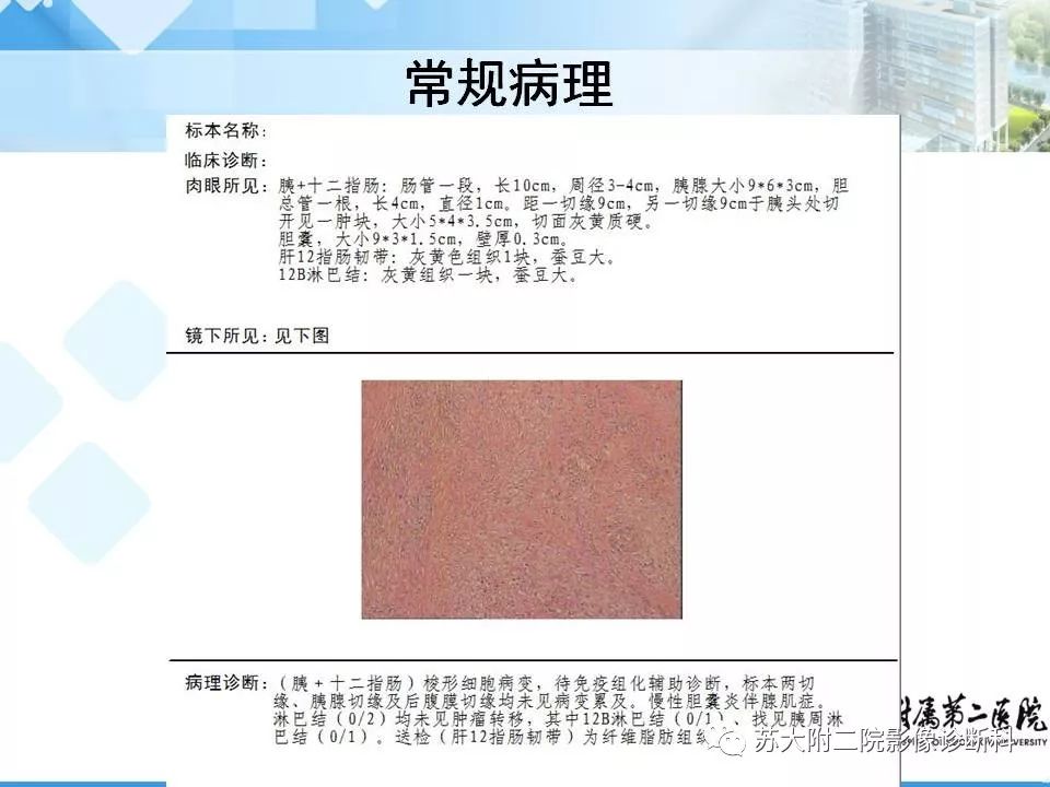 【病例】胰腺囊性病变3例影像诊断-29