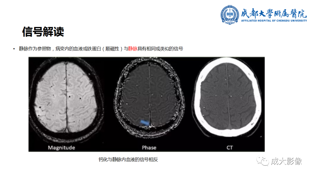 【PPT】SWI在中枢神经系统疾病中的应用-4