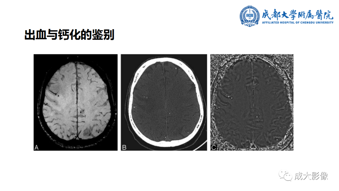 【PPT】SWI在中枢神经系统疾病中的应用-6