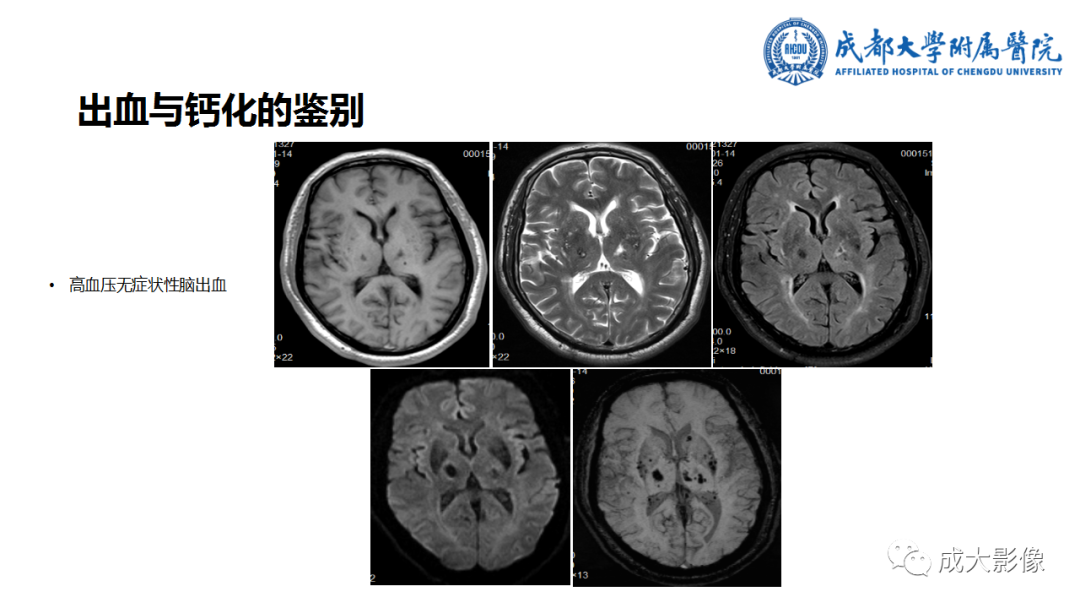 【PPT】SWI在中枢神经系统疾病中的应用-7