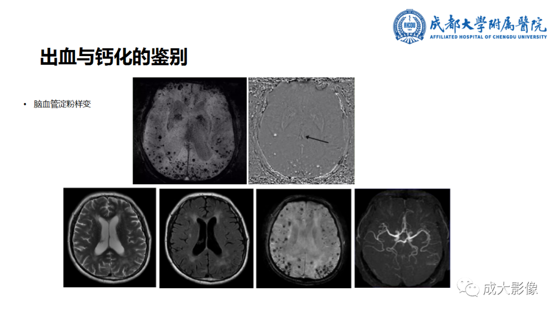 【PPT】SWI在中枢神经系统疾病中的应用-8