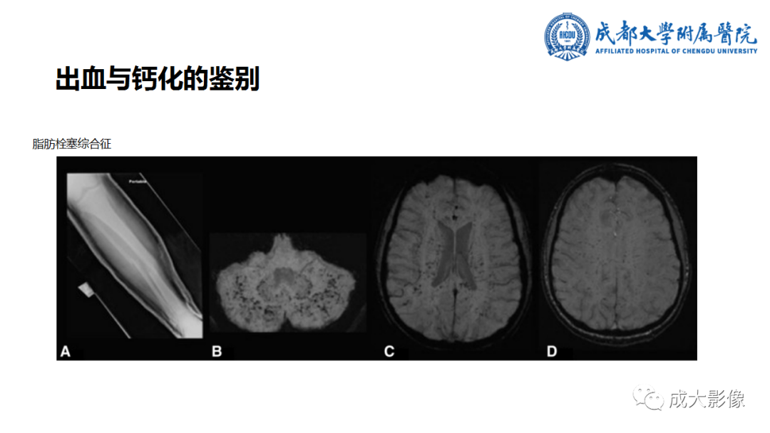 【PPT】SWI在中枢神经系统疾病中的应用-9