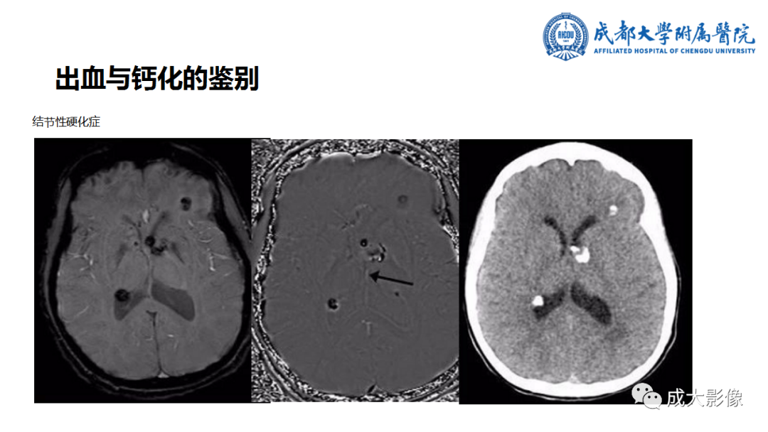 【PPT】SWI在中枢神经系统疾病中的应用-10