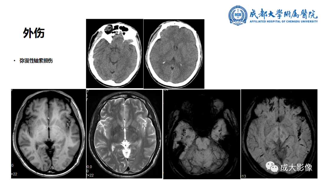 【PPT】SWI在中枢神经系统疾病中的应用-11