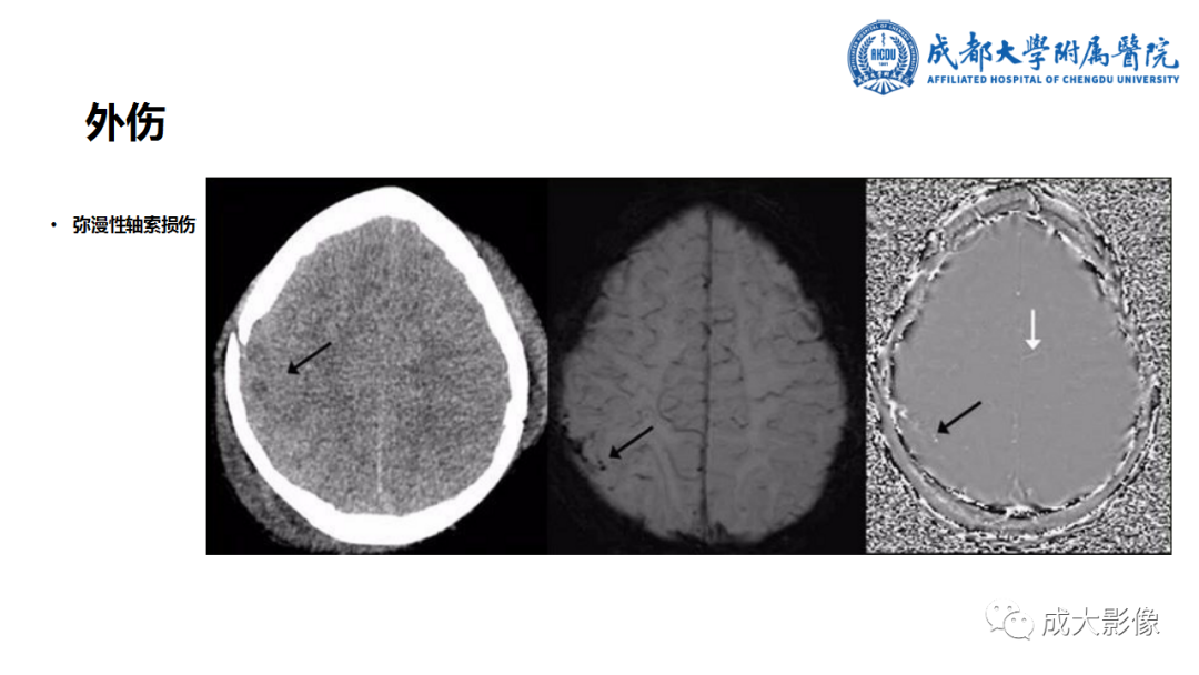 【PPT】SWI在中枢神经系统疾病中的应用-12