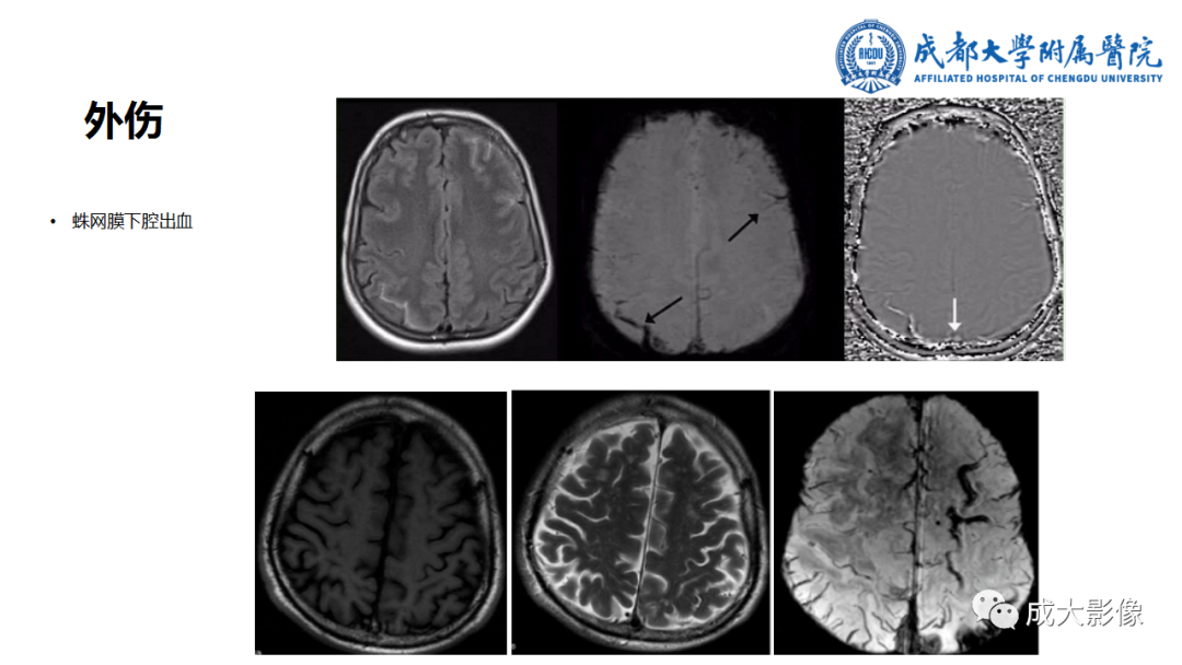 【PPT】SWI在中枢神经系统疾病中的应用-13