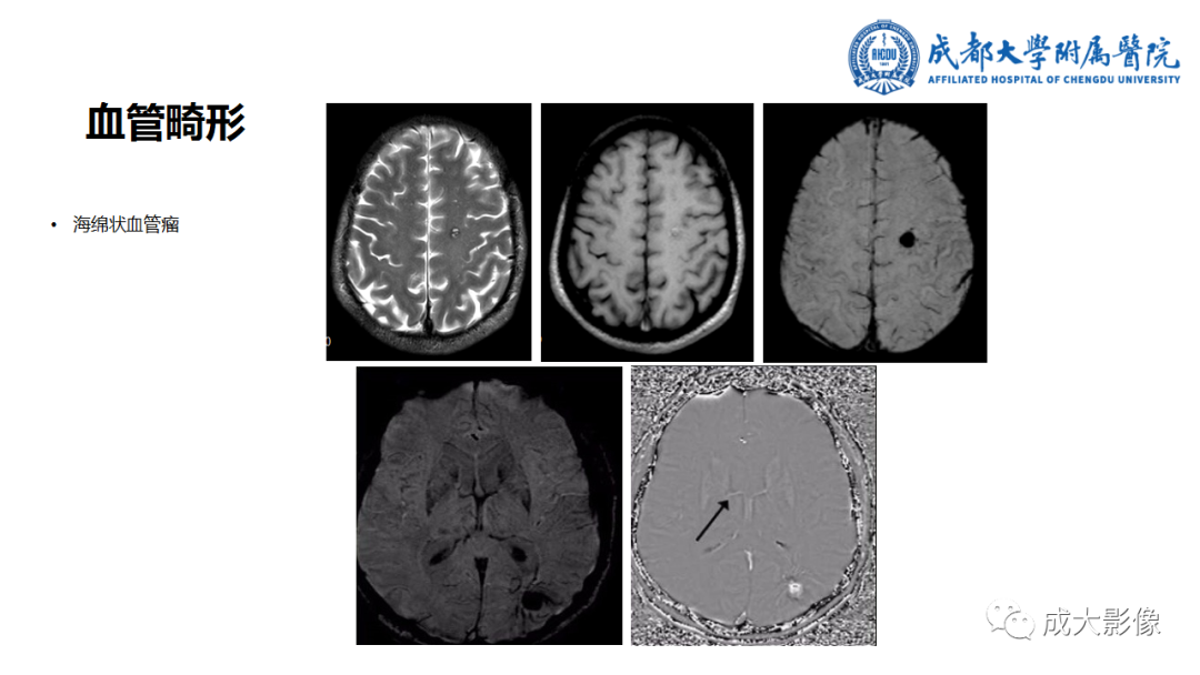 【PPT】SWI在中枢神经系统疾病中的应用-15