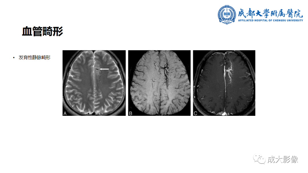 【PPT】SWI在中枢神经系统疾病中的应用-16
