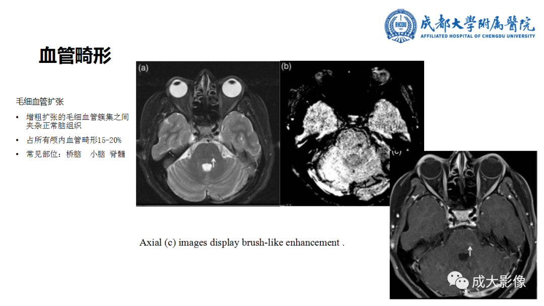 【PPT】SWI在中枢神经系统疾病中的应用-17