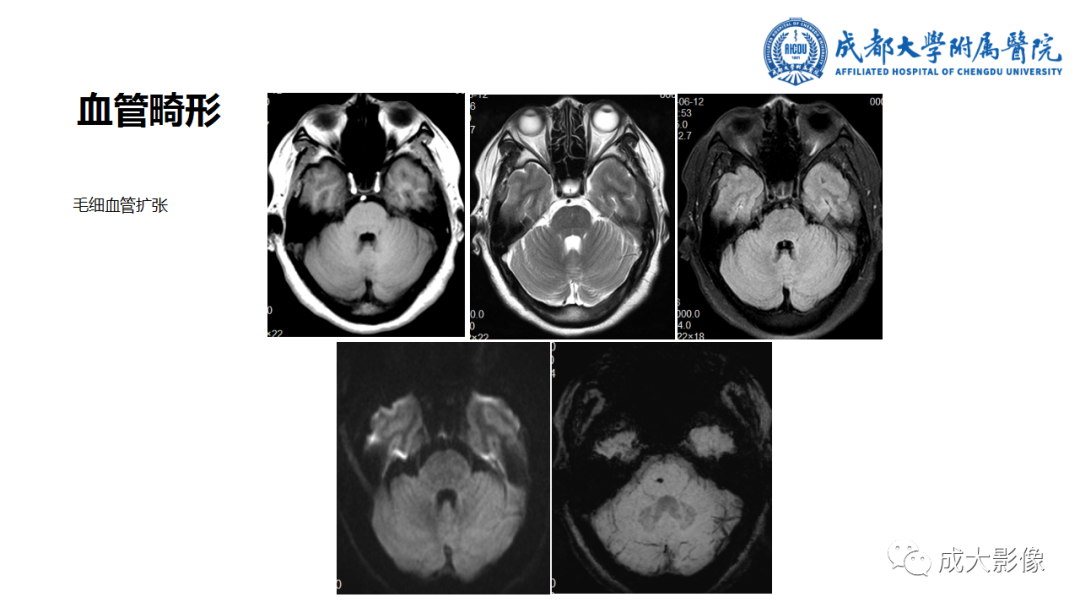 【PPT】SWI在中枢神经系统疾病中的应用-18