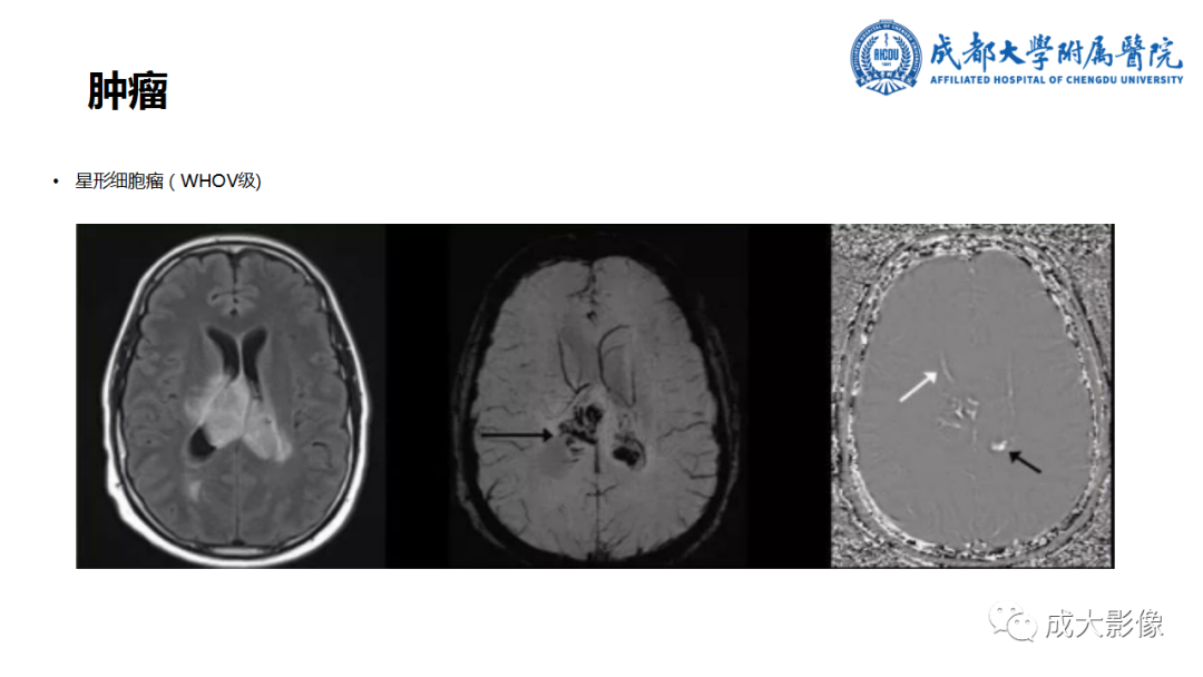 【PPT】SWI在中枢神经系统疾病中的应用-21