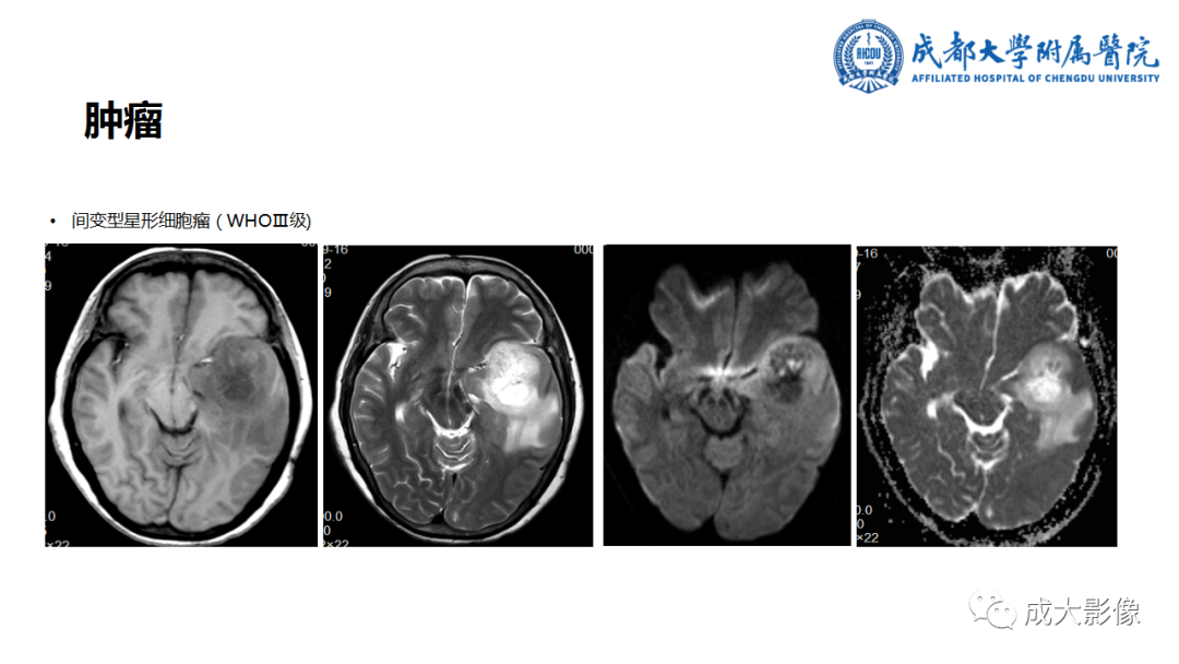 【PPT】SWI在中枢神经系统疾病中的应用-22
