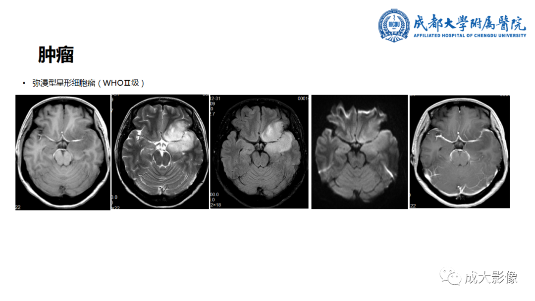 【PPT】SWI在中枢神经系统疾病中的应用-24