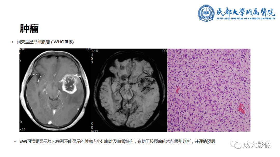 【PPT】SWI在中枢神经系统疾病中的应用-23