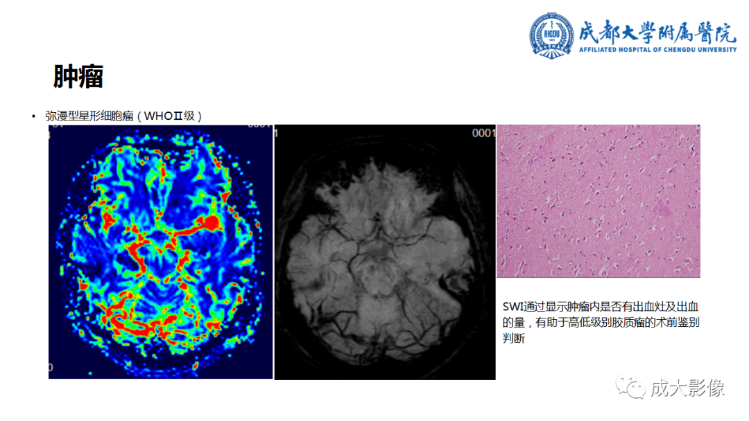 【PPT】SWI在中枢神经系统疾病中的应用-25