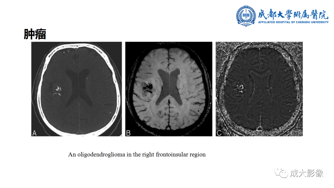 【PPT】SWI在中枢神经系统疾病中的应用-26