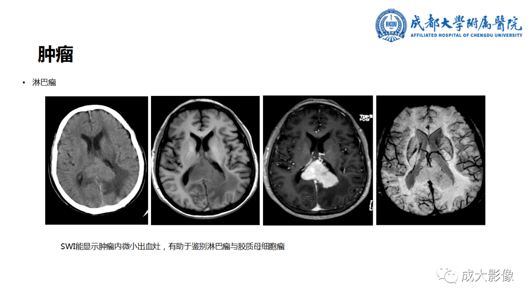 【PPT】SWI在中枢神经系统疾病中的应用-27