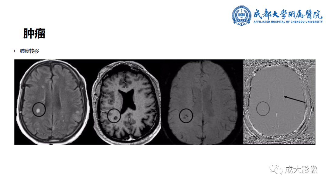 【PPT】SWI在中枢神经系统疾病中的应用-28