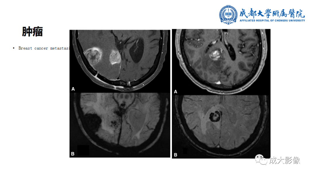 【PPT】SWI在中枢神经系统疾病中的应用-29