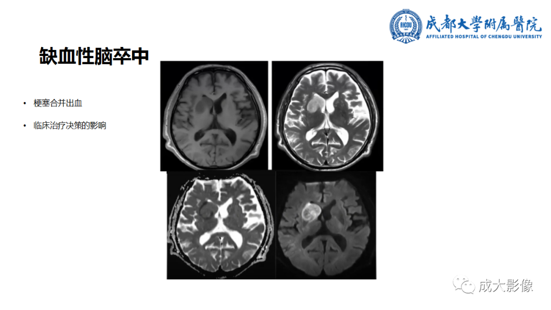 【PPT】SWI在中枢神经系统疾病中的应用-31