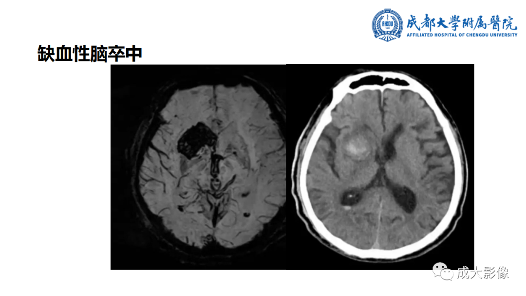 【PPT】SWI在中枢神经系统疾病中的应用-32