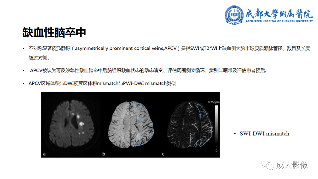 【PPT】SWI在中枢神经系统疾病中的应用-33