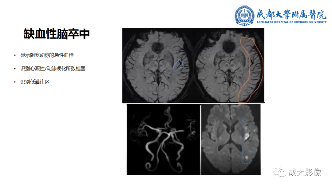 【PPT】SWI在中枢神经系统疾病中的应用-34