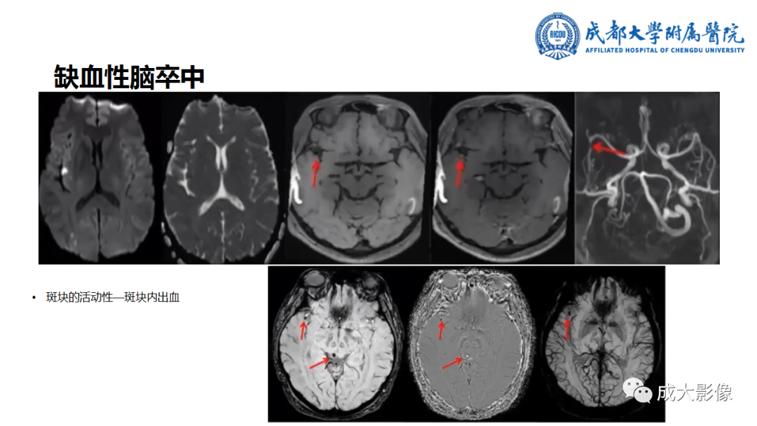 【PPT】SWI在中枢神经系统疾病中的应用-35