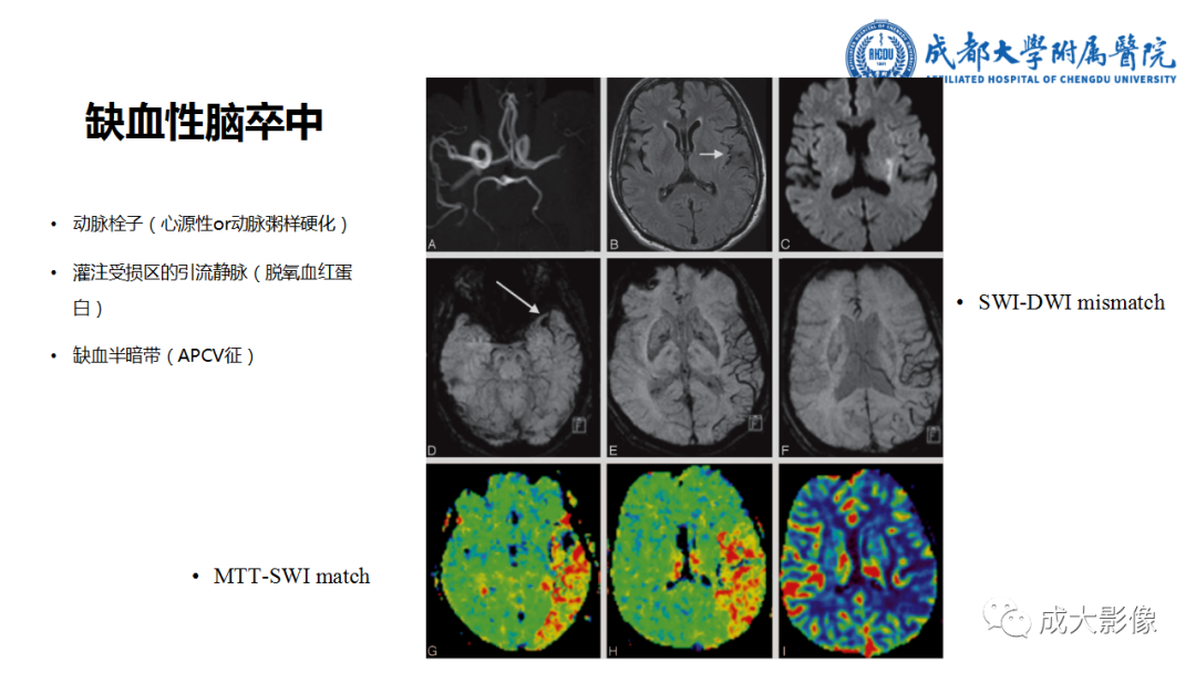 【PPT】SWI在中枢神经系统疾病中的应用-36
