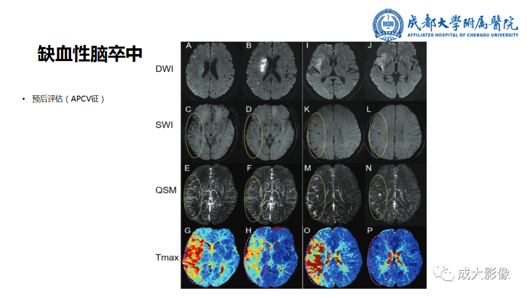 【PPT】SWI在中枢神经系统疾病中的应用-37