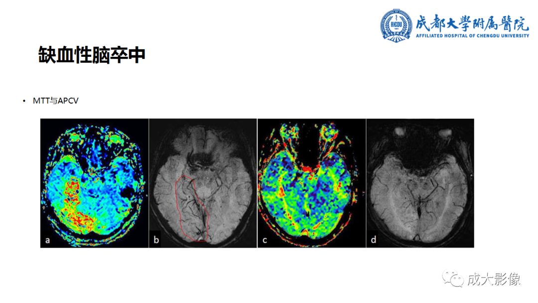 【PPT】SWI在中枢神经系统疾病中的应用-38