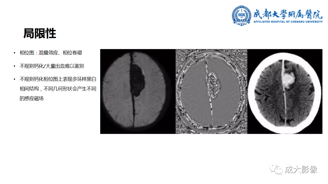【PPT】SWI在中枢神经系统疾病中的应用-40